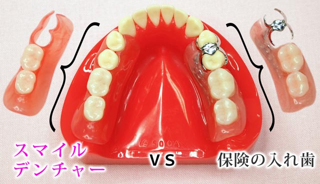 ノンクラスプ義歯：スマイルデンチャー | 精密入れ歯・義歯相談室 | 鎌倉・藤沢 グリーン歯科医院